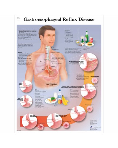 Gastroesophageal Reflux Disease Chart (GERD)
